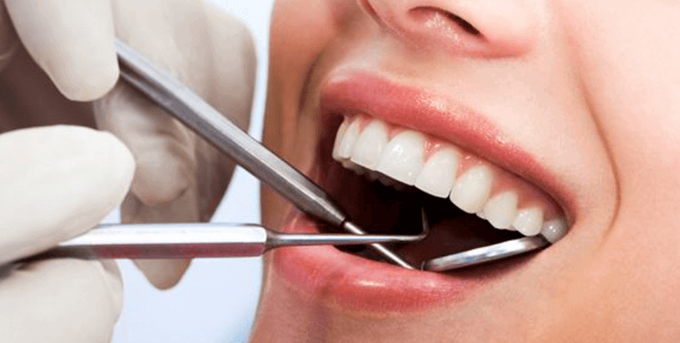 Šta je zubni kamenac?
