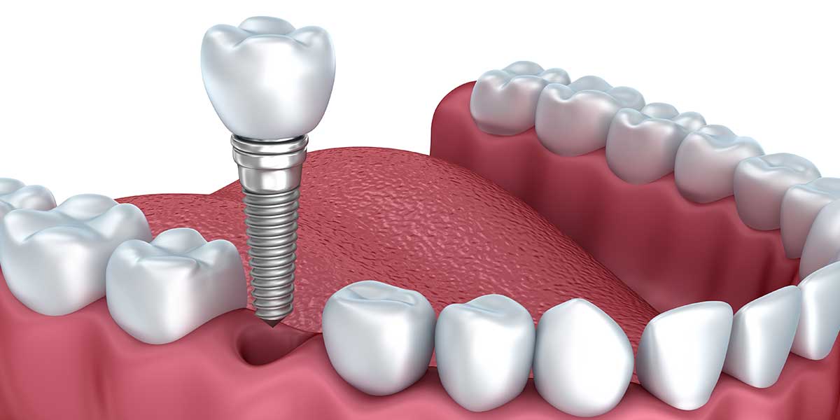 Dentalni implanti
